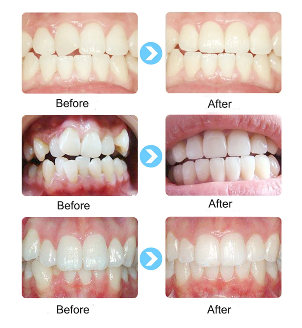Appareil Orthodontique Formateur T4A pour Alignement et Blanchiment des Dents Adultes .